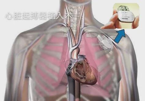 【扩散】2024年10月8日全国高血压日——“精准测量有效控制健康长寿”(图6)