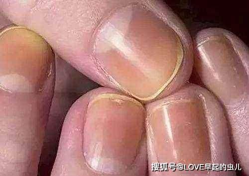 只需审视手势！肝脏健康的秘诀就在此四个迹象作为测量准则(图4)
